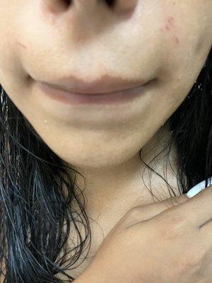 Cuts on face from wax