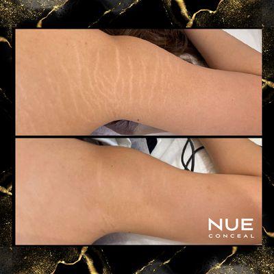 Stretch mark camouflage using NUE Conceal pigments.