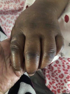 Swollen hand