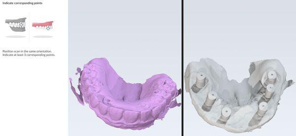 full mouth implant digital impression