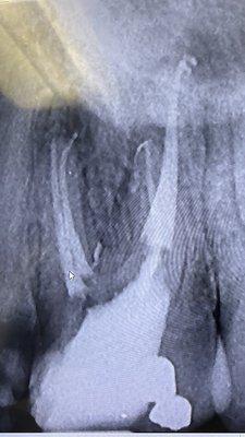 Root canal 4 canals covered