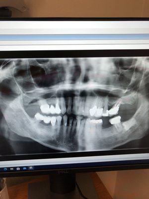 X ray at lst appointment