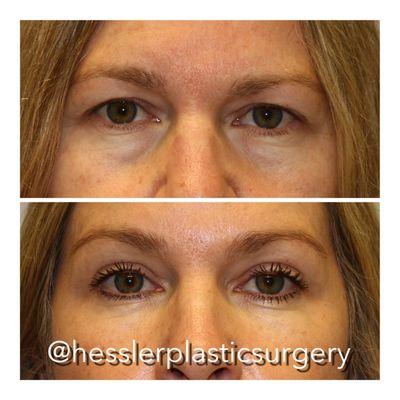 This lovely woman was concerned with the tired appearance of her eyes. She had an eyelet for a rejuvenated, refreshed appearance.