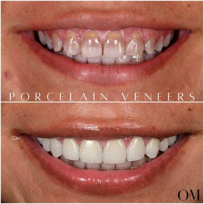 10 Porcelain Veneers to mask deep Tetracycline Staining