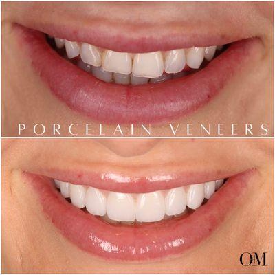 10 Porcelain Veneers to brighten up this smile and reverse the years