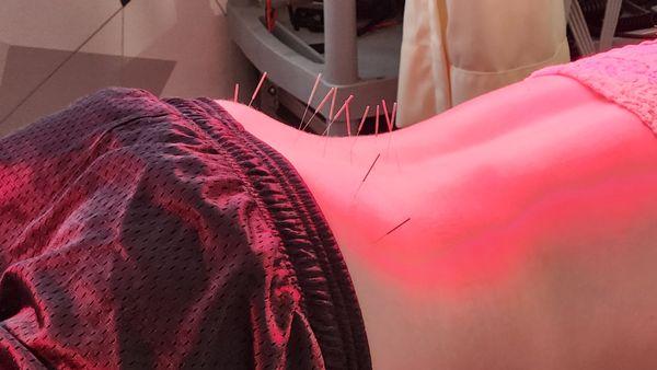 Low Back Pain acupuncture