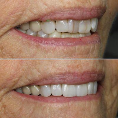 Smile makeover to fix fractured and misaligned front teeth completed by Dr. Rob. Such a seamless result