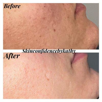 Look at these results! Let me help your skin!