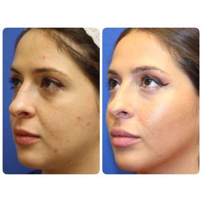 ENHANCE facial Contouring by Dr. Irene Gladstein