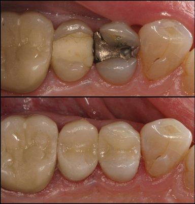 Safe Amalgam Removal Technique