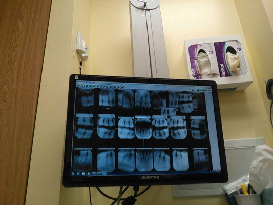 My x-rayed chompers.