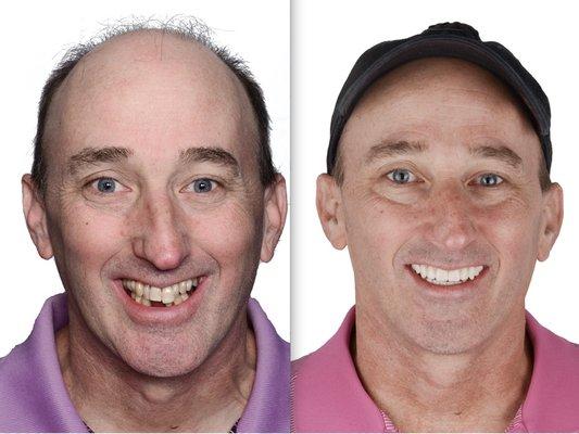 John - before & after All-on-4 dental implants