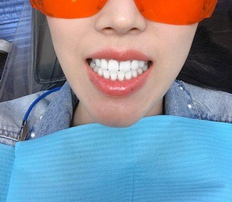 Teeth whitening