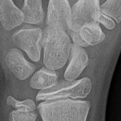 Pediatric  and adolescent scaphoid and wrist fractures may  not  be readily apparent on the initial X-rays