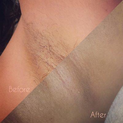 Sugar underarm hair removal