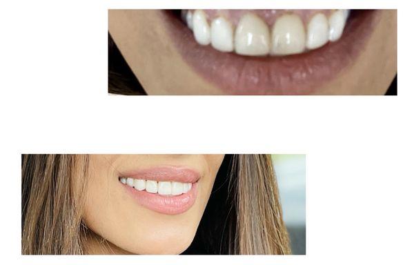 Veneers before and after