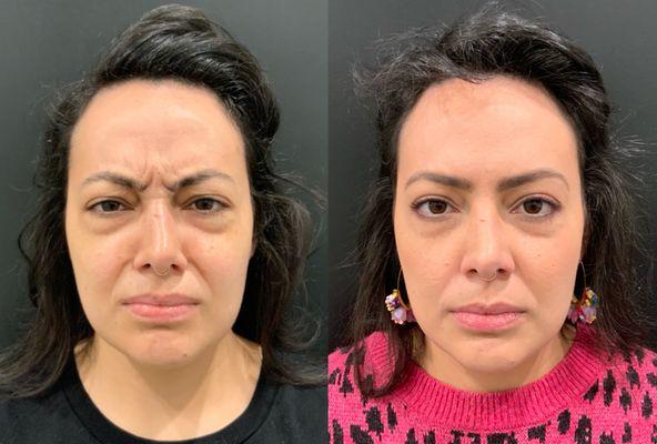 Botox before and after