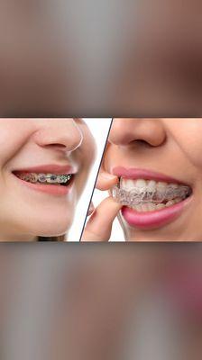 Braces vs Clear Aligners