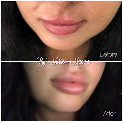 Before image was botched work done at another MedSpa. The after photo was after I gave this client the desired lip enhancement she asked for