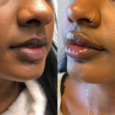 Lip fillers