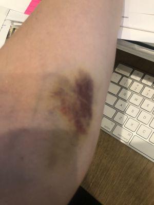 5th day of bruising!