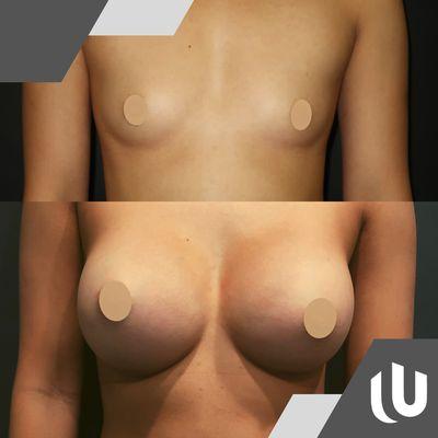 United Plastic Surgery | Breast Augmentation