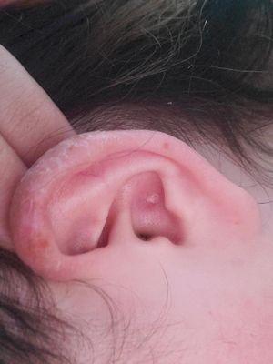 Chemical burnt ear after using medication