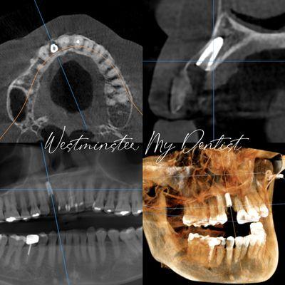 Immediate Dental Implant can replace a missing tooth seamlessly and function as a natural tooth.