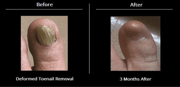 Permanent correction of deformed toenails. $280 includes everything. Return to normal shoes and normal activities one hour after the surgery