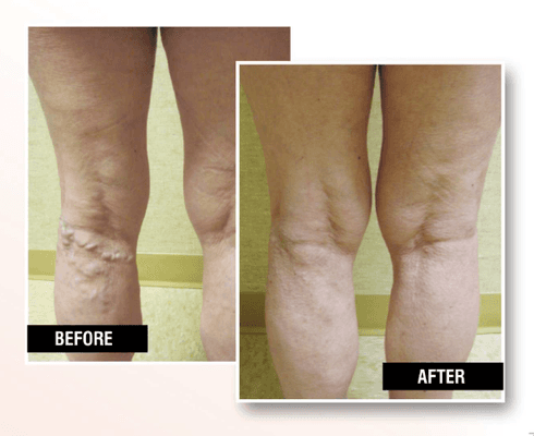 Varicose vein treatment in brooklyn