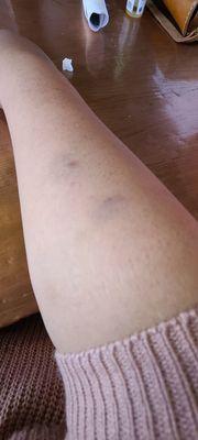 Waxing bruises on right arm, a couple of days after service.