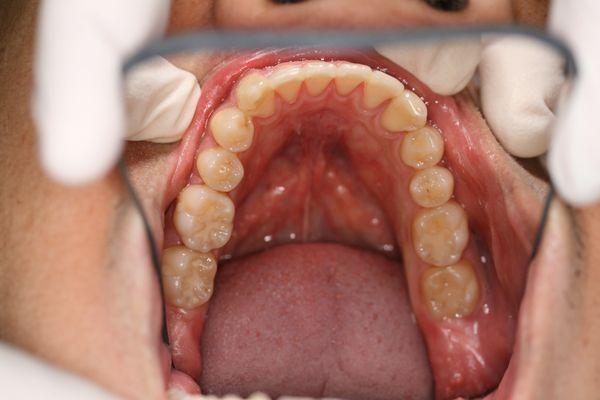 Invisalign Treated Upper Teeth