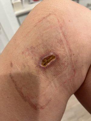 Open wound (possibly staph infection)