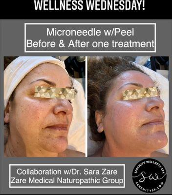 Glowing with Microneedling