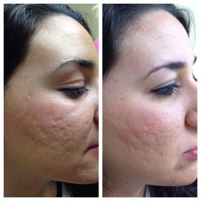 Microneedling Acne