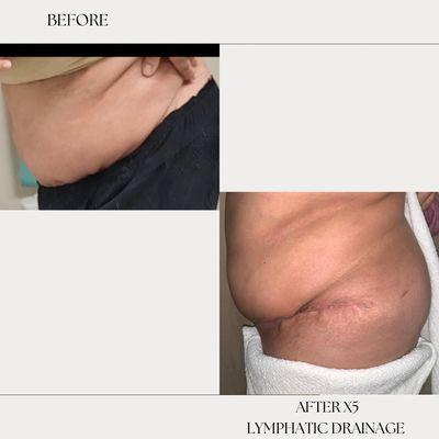 Post op. ; before the lymphatic drainage and after