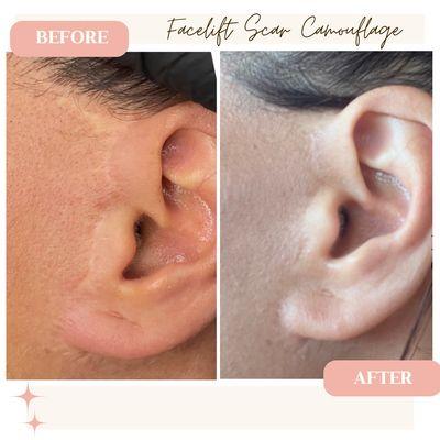 Face Lift sugery? We got you covered with our skin tone camouflage!