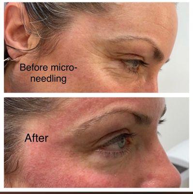 Micro-needling before and after treatment. Some redness but clears up within 12-24 hrs.