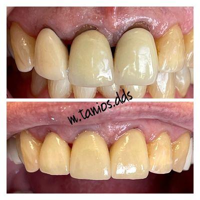 Replacing old ill-fitting crowns with new all porcelain esthetic crowns for our wonderful patient.