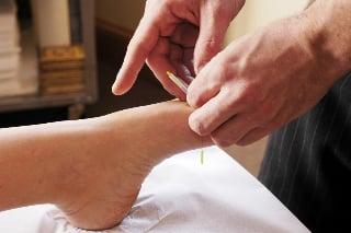 Acupuncture Treatment