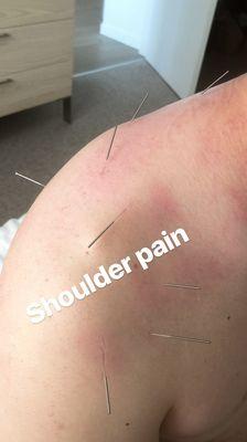 Shoulder pain