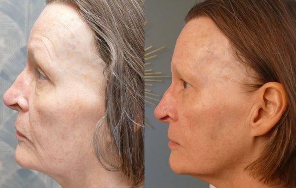 8 Point Face Lift Facial before and after photo