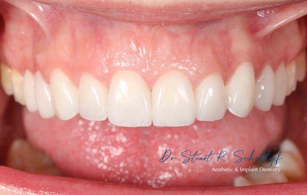 10 veneers to enhance the appearance of this patient's teeth