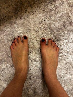 Comparison of skin color, right big toe infected