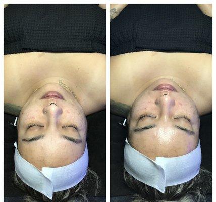 Before and after a Hydrafacial.. look at that GLOW!