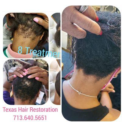 Recovered hair in just 7 treatments.