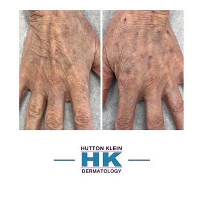 Before/After Hand Filler to reduce the appearance of veins and tendons while restoring lost volume.