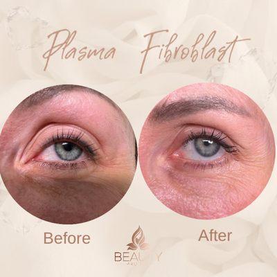 Plasma Fibroblast Skin Tightening for droopy upper eyelids. Results is after one month