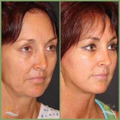 Face and Neck lift (ContourLift)