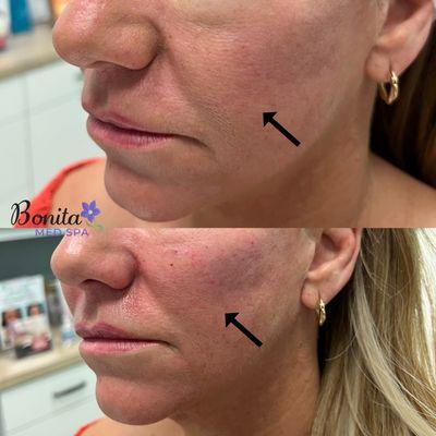 Cheek Restoration with Restylane Lyft